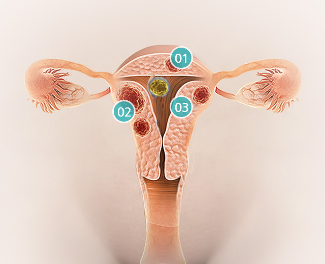자궁근종 하이푸치료