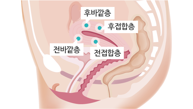 자궁선근종 하이푸치료